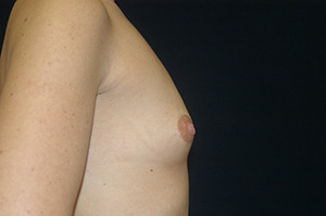 Breast Augmentation 2c